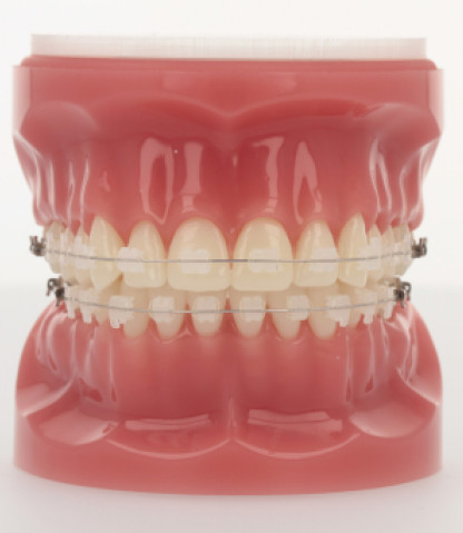 20/40 Brackets with Iconix Wire