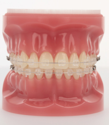 Radiance Plus® - Hooks on Cuspids