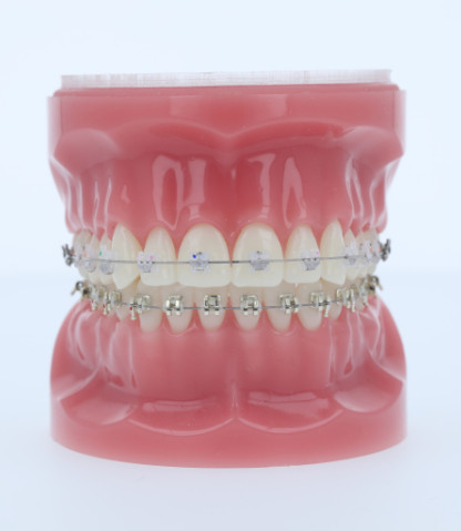 Empower® Clear/Iconix Bracket Comparison