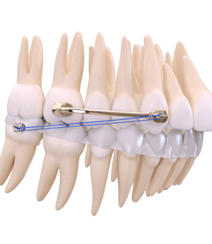 PowerBar® Class II Corrector